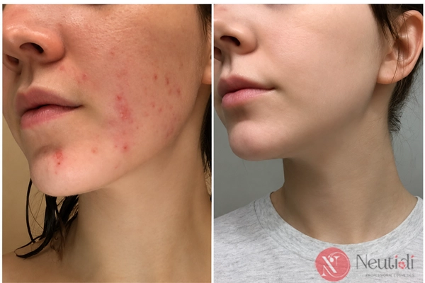 Niacinamide cần thời gian để phát huy tác dụng