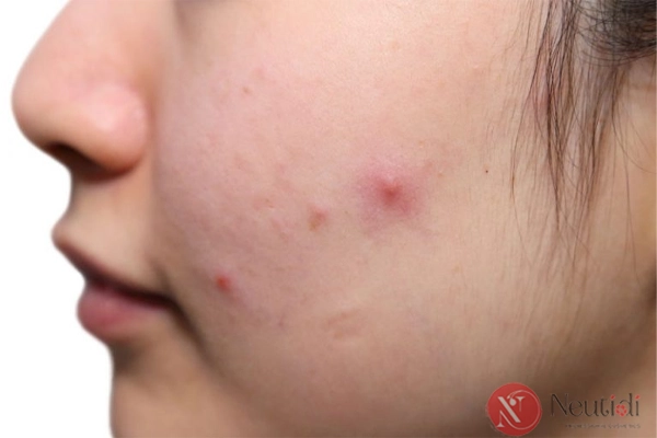 Nhận diện 6 loại mụn thường gặp ở tuổi dậy thì & Cách xử lý 5 Lý do tuổi dậy thì dễ bị mụn trứng cá