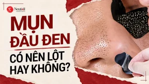 Có nên lột mụn đầu đen không?