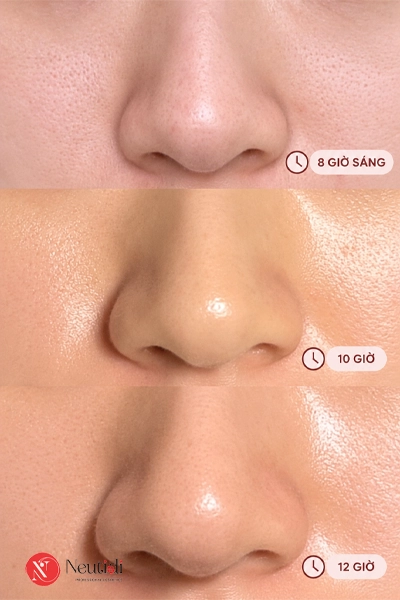 Làm sao để da mặt không bị bóng nhờn, đổ dầu thừa trong suốt cả ngày? 2 Da dễ bóng nhờn, đổ dầu chỉ sau vài tiếng