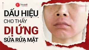 Dị ứng sữa rửa mặt: Nguyên nhân, dấu hiệu, bao lâu hết và cách xử lý 7 Tìm hiểu về dị ứng sữa rửa mặt