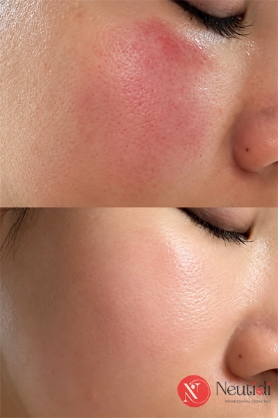 Dị ứng sữa rửa mặt: Nguyên nhân, dấu hiệu, bao lâu hết và cách xử lý 5 Dị ứng sữa rửa mặt bao lâu thì hết?