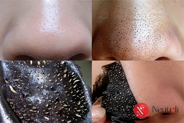 Có nên lột mụn đầu đen? Khi nào nên tránh 2 Có nên lột mụn đầu đen?