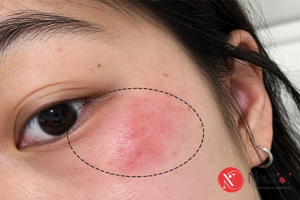 Dị ứng sữa rửa mặt: Nguyên nhân, dấu hiệu, bao lâu hết và cách xử lý 4 Cách xử lý khi dùng sữa rửa mặt bị dị ứng