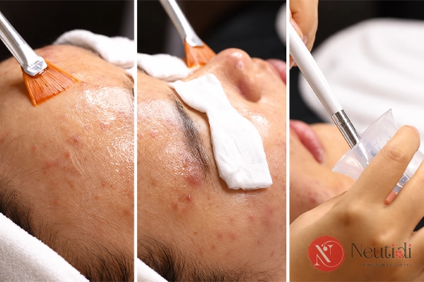 BHA nồng độ cao thường dùng khi peel da ở phòng khám da liễu