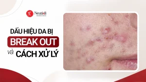 Da bị breakout nổi mụn