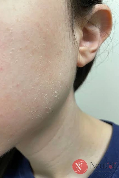 BHA dùng hằng ngày được không? Tần suất và giờ dùng đúng 6 Dấu hiệu dùng BHA quá nhiều