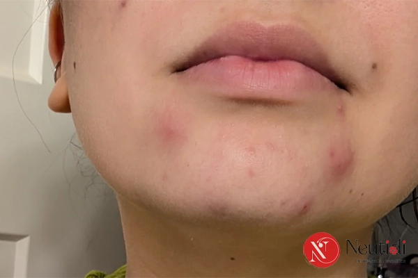 7 Nguyên nhân gây nổi mụn ở quai hàm & Cách xử lý hiệu quả 7 Mụn ở quai hàm bao lâu thì hết?