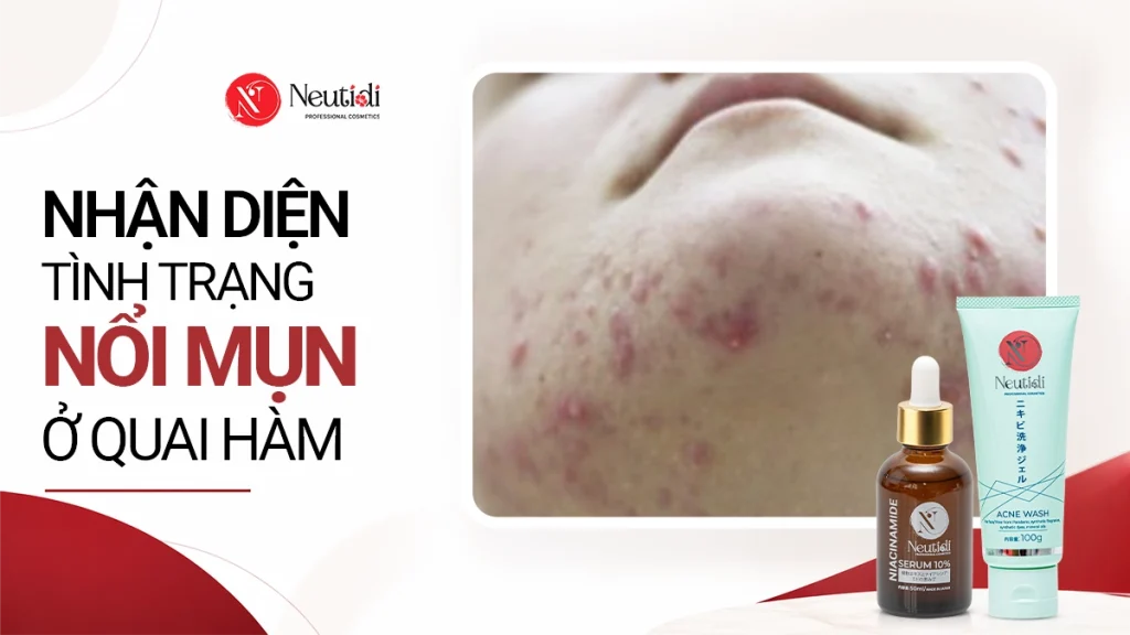 7 Nguyên nhân gây nổi mụn ở quai hàm & Cách xử lý hiệu quả 1 Nguyên nhân gây nổi mụn ở quai hàm và cách xử lý