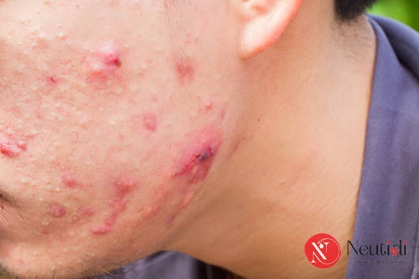 7 Nguyên nhân gây nổi mụn ở quai hàm & Cách xử lý hiệu quả 4 Các yếu tố khiến hai bên quai hàm nổi mụn trứng cá