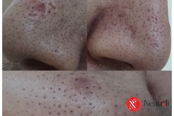 Mẹo dùng BHA trị mụn đầu đen hiệu quả & lưu ý khi dùng 2 BHA có thể xử lý mụn đầu đen hiệu quả